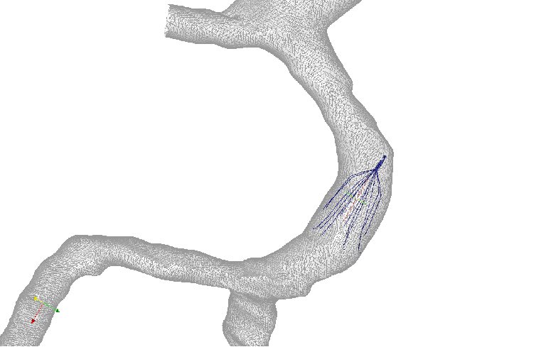 Left IVC Model