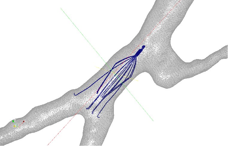 Retroaortic IVC Model